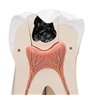 Molar uriaș cu cavități dentare Model de dinți umani, de 15 ori - dimensiune naturala, 6 parte 