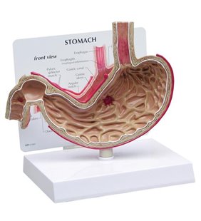 Model de stomac cu ulcere