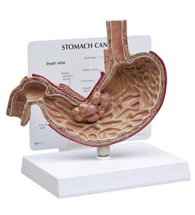 Model de cancer la stomac