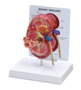 Model de rinichi bolnav