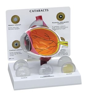 Ochi de cataractă