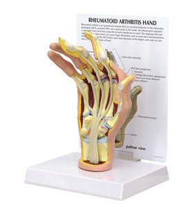 Model de mână de artrită reumatoidă