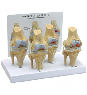 Set de modele de genunchi osteo în 4 etape