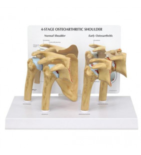 Modelul umărului osteoartritei (OA) în etapă (OA)