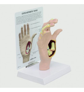 Model de mână osteoartrită