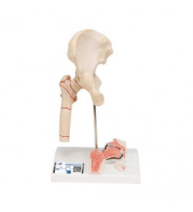 Model de fractură femurală umană și osteoartrită de șold 
