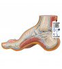 Modelul Hollow Foot (PES Cavus) 