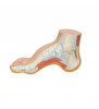 Modelul Hollow Foot (PES Cavus) 