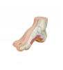 Modelul Hollow Foot (PES Cavus) 