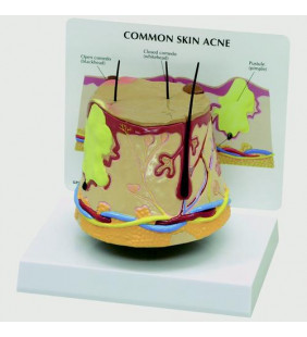Model de acnee pentru piele (supradimensionat)