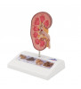 Model de piatră de rinichi 