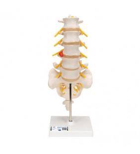 Model de coloană coloană vertebrală lombară umană cu disc intervertebral dorso lateral prolapsat 