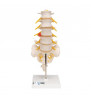 Model de coloană coloană vertebrală lombară umană cu disc intervertebral dorso lateral prolapsat 