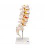 Model de coloană coloană vertebrală lombară umană cu disc intervertebral dorso lateral prolapsat 