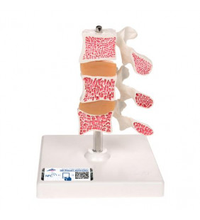 Model de osteoporoză umană de lux (3 vertebre cu discuri), detașabil pe stand 
