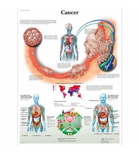 Diagrama cancerului