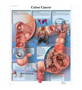 Diagrama de cancer de colon