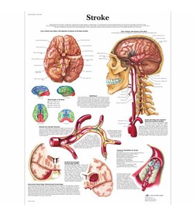 Grafic de accident vascular cerebral