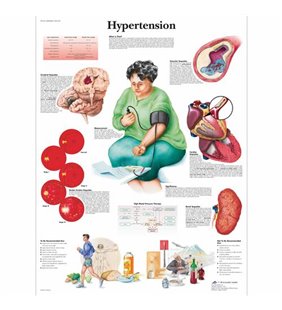 Grafic de hipertensiune