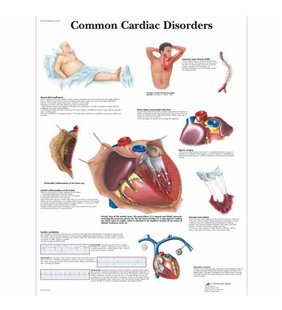 Graficul de tulburări cardiace comune