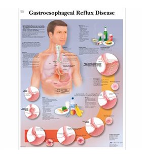 Graficul bolilor de reflux gastroesofagian (GERD)