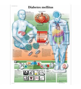 Grafic - Diabet zaharat Mellitus