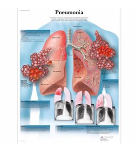 Diagrama Pneumoniei