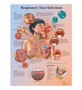 Grafic de infecții ale tractului respirator