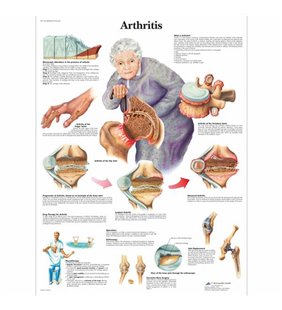 Grafic de artrită