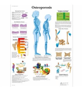 Graficul osteoporozei