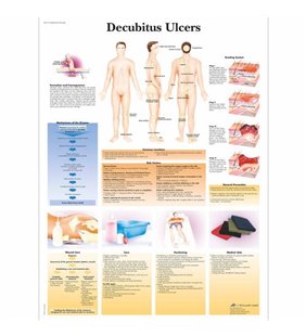 Graficul ulcerilor decuditus